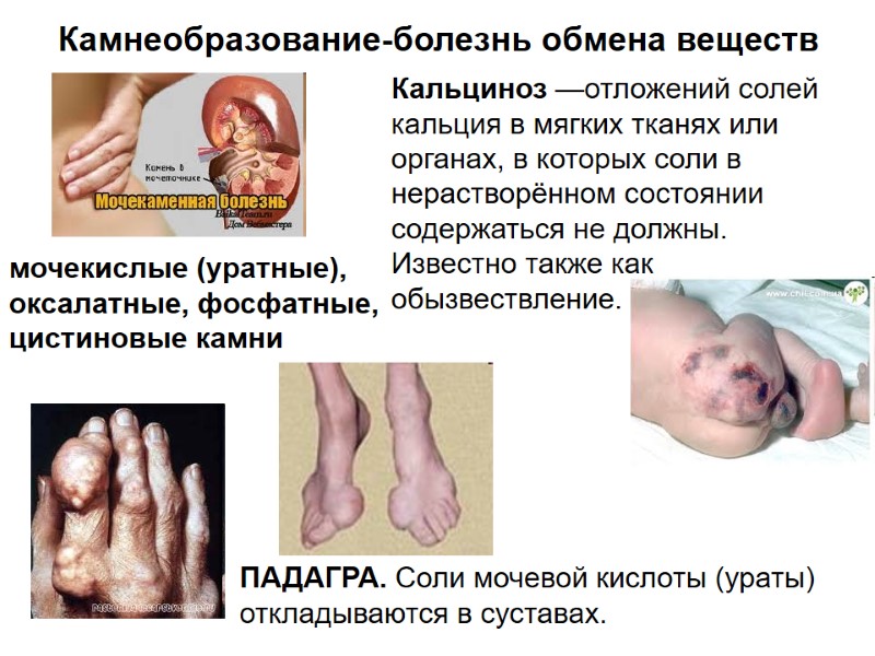 Камнеобразование-болезнь обмена веществ ПАДАГРА. Соли мочевой кислоты (ураты) откладываются в суставах.  мочекислые (уратные),